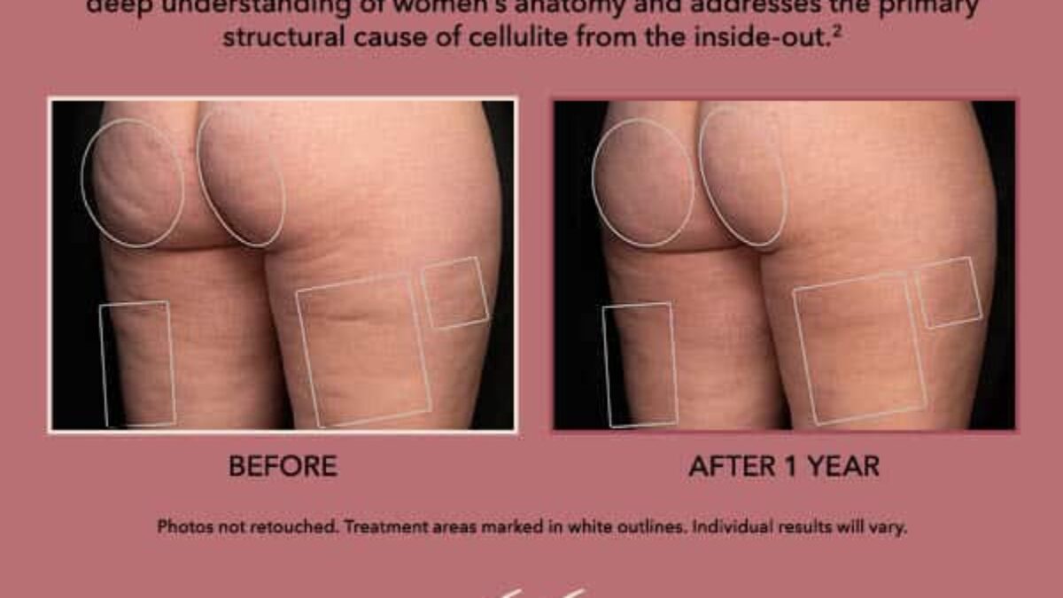 Aveli Cellulite Treatment - South Jersey Aesthetics