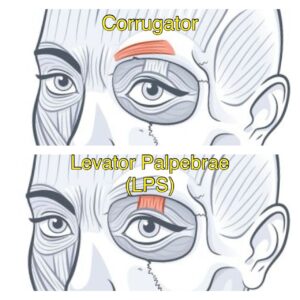 Anatomical illustration of facial muscles, highlighting the Corrugator and Levator Palpebrae Superioris (LPS) muscles above the eye
