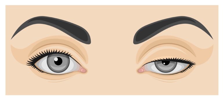 Illustration of a person's face showing a normal eye on the left and an eye with eyelid ptosis on the right