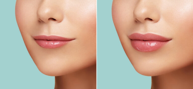 Lip Fillers | South Jersey Aesthetics