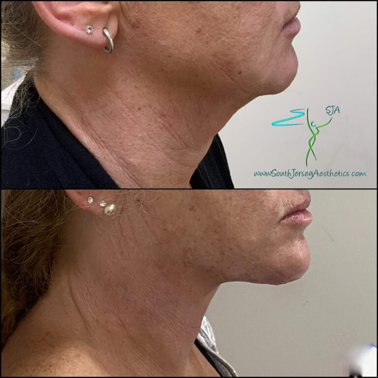 Ultra Neck Lift