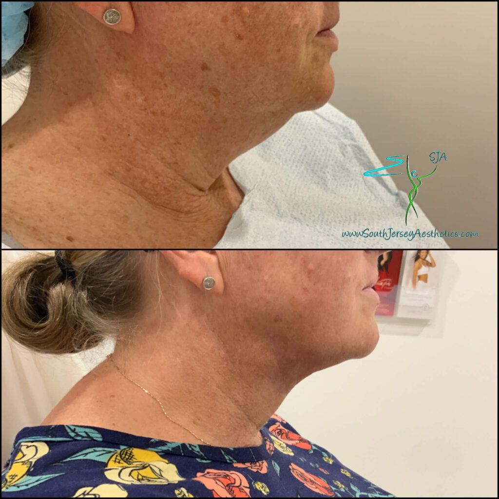 Ultra Neck Lift