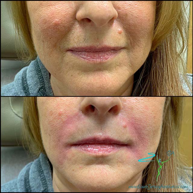 nasolabial fold fillers galleries 63643