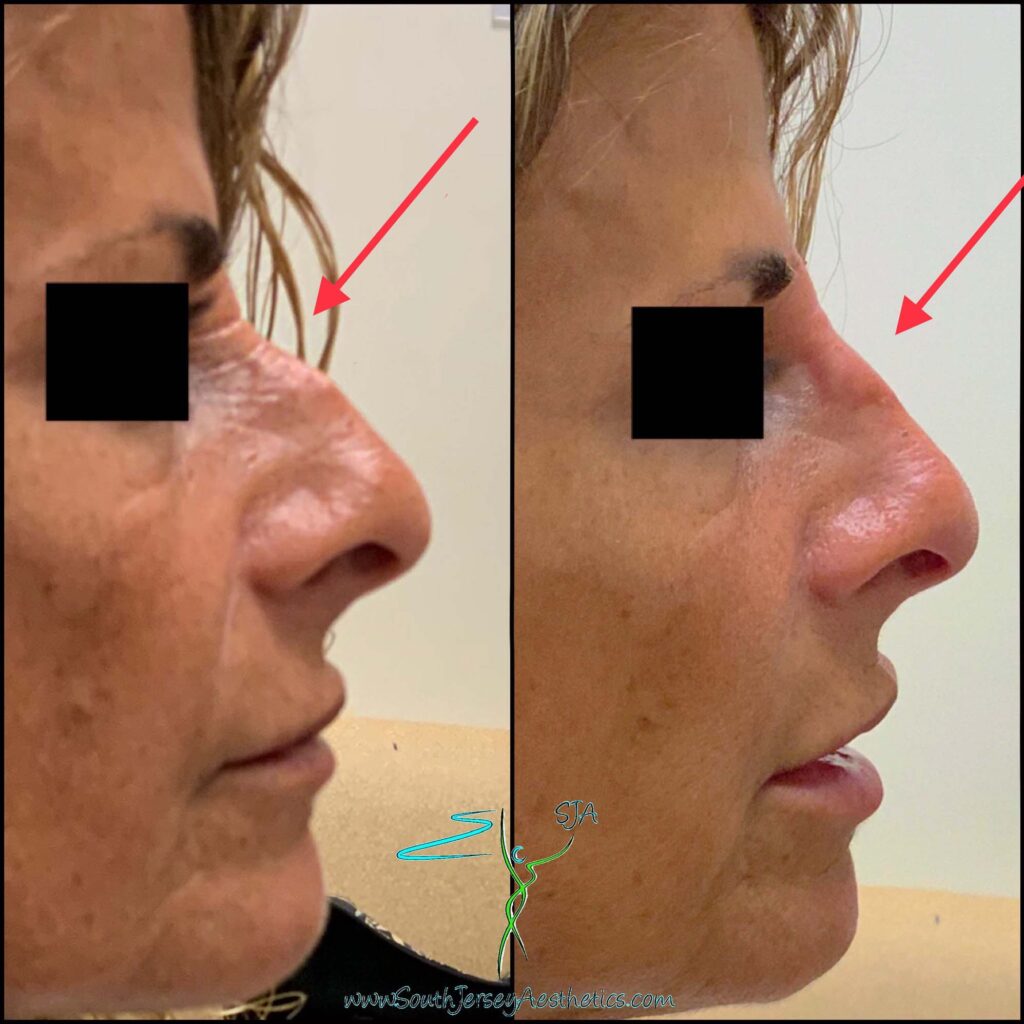 rhinoplasty galleries 63627