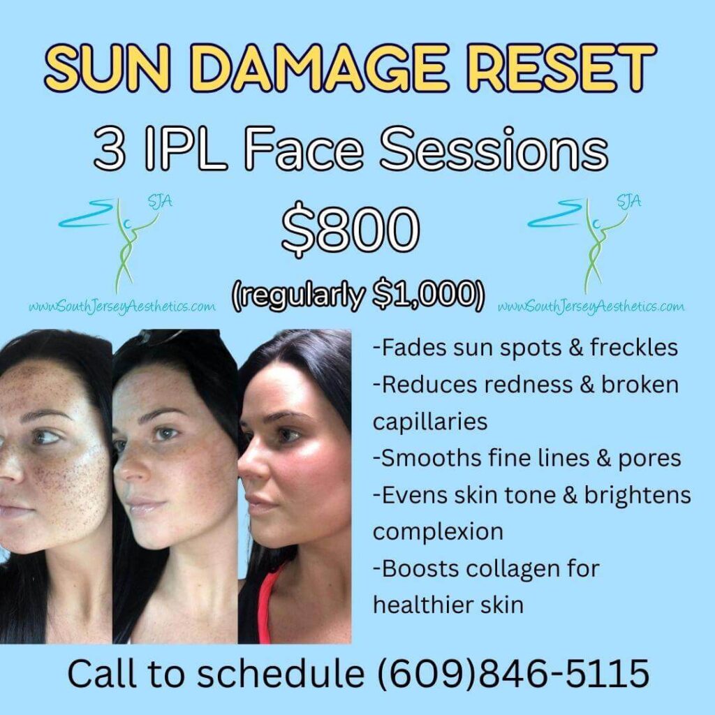 Sun Damage Reset 3 IPL Treatments