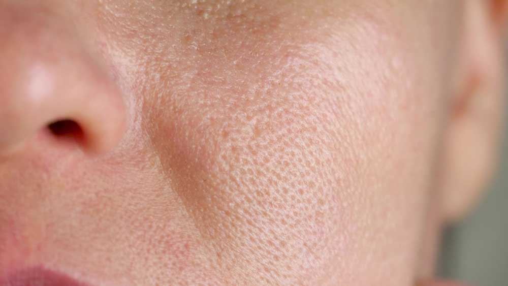 large pore treatment