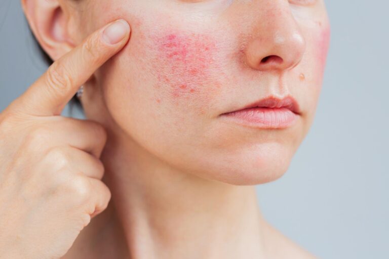 rosacea featured