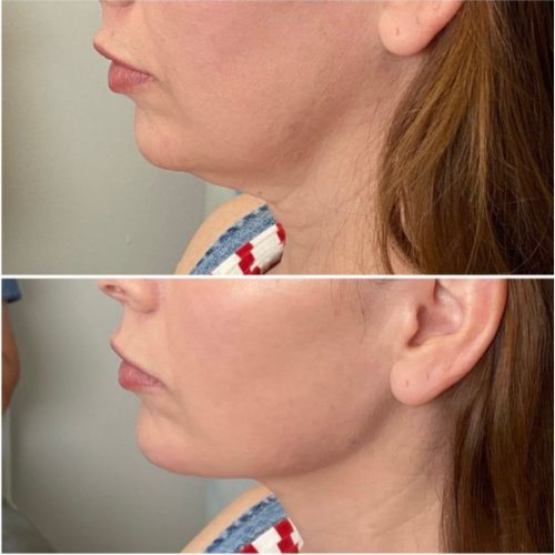 Bellafill jaw line