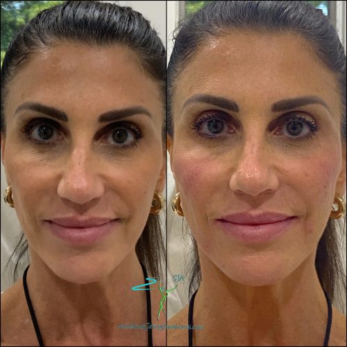south jersey bellafill before and after